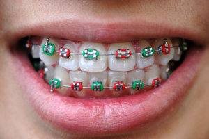 bluffdale ut orthodontist what does your braces rubber band color say about you