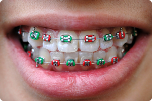 bluffdale ut orthodontist what does your braces rubber band color say about you