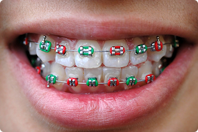 bluffdale ut orthodontist what does your braces rubber band color say about you