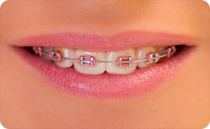 west jordan ut orthodontist healthy teeth braces