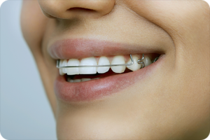 riverton ut orthodontist retainer care