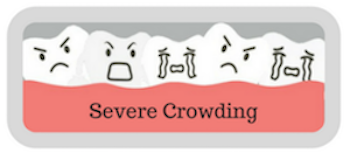 severe-crowding-quiz